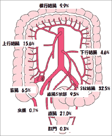 の 大腸 初期 症状 癌